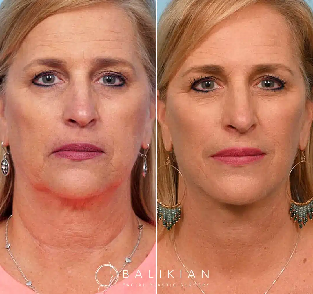 Front view before and after deep plane facelift and neck lift in San Diego showing lifted lower face, reduced jowls, and a smoother neckline.