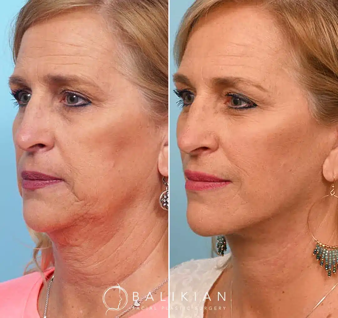 Three-quarter view before and after deep plane facelift and neck lift in San Diego highlighting defined jawline, tightened neck, and refreshed appearance.