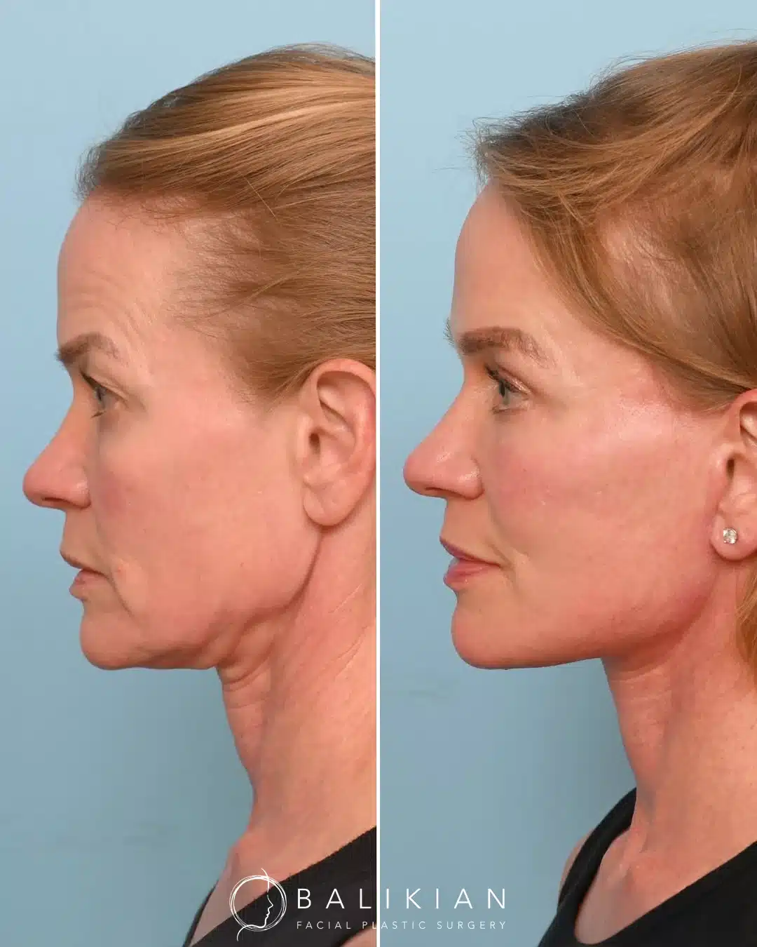 Profile before and after facelift and neck lift showing sharper chin and smooth neck contour.