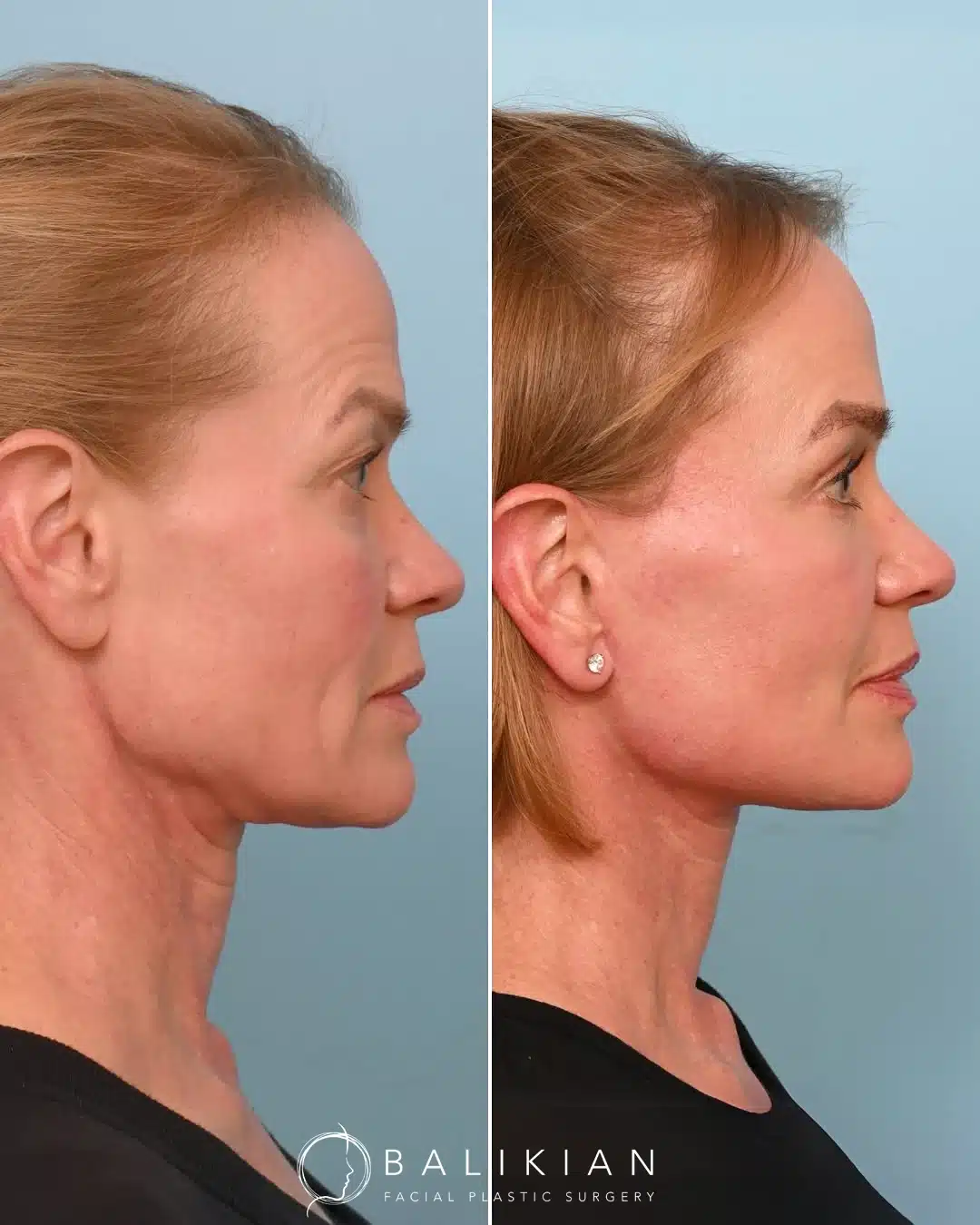 Before and after profile view with defined jawline and youthful neck angle.