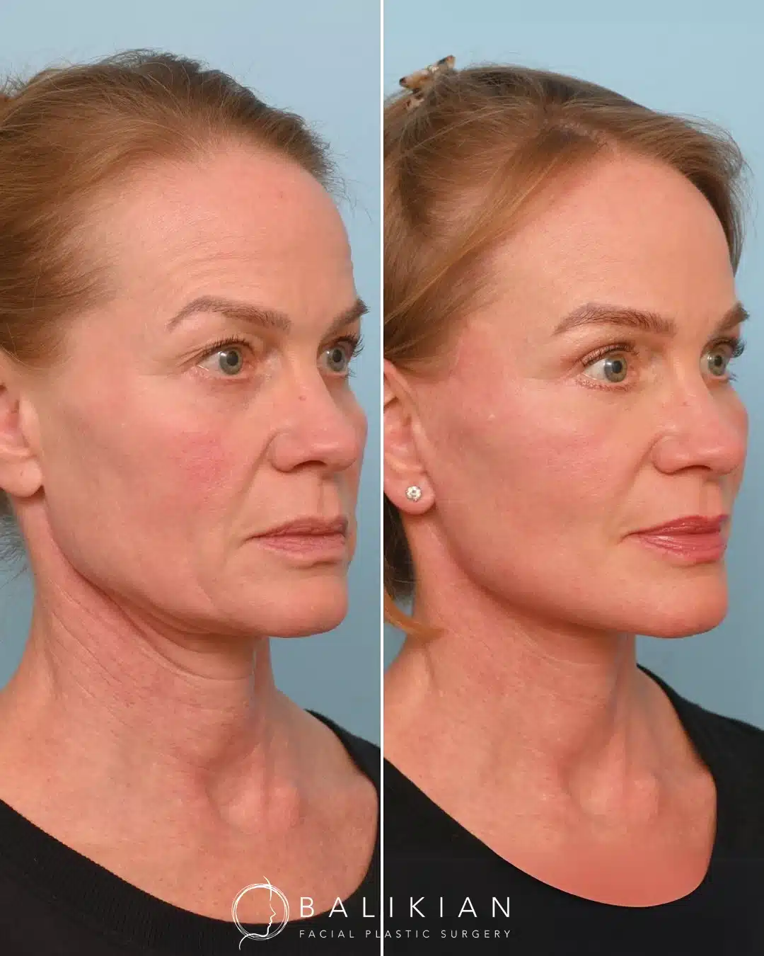 Facelift and neck lift before and after with refined jawline and smoother neck.