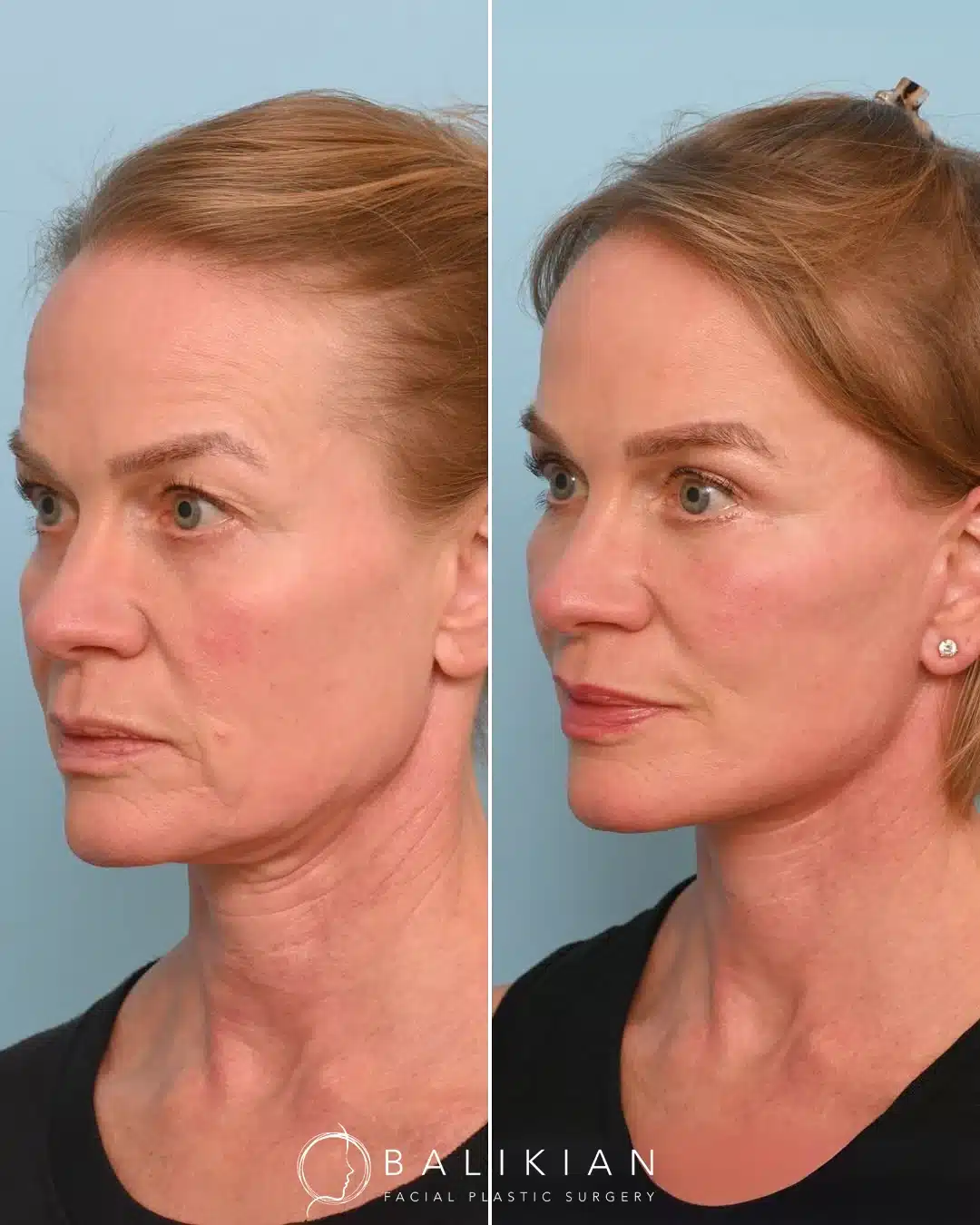 Before and after facelift and neck lift showing lifted cheeks and defined jawline.