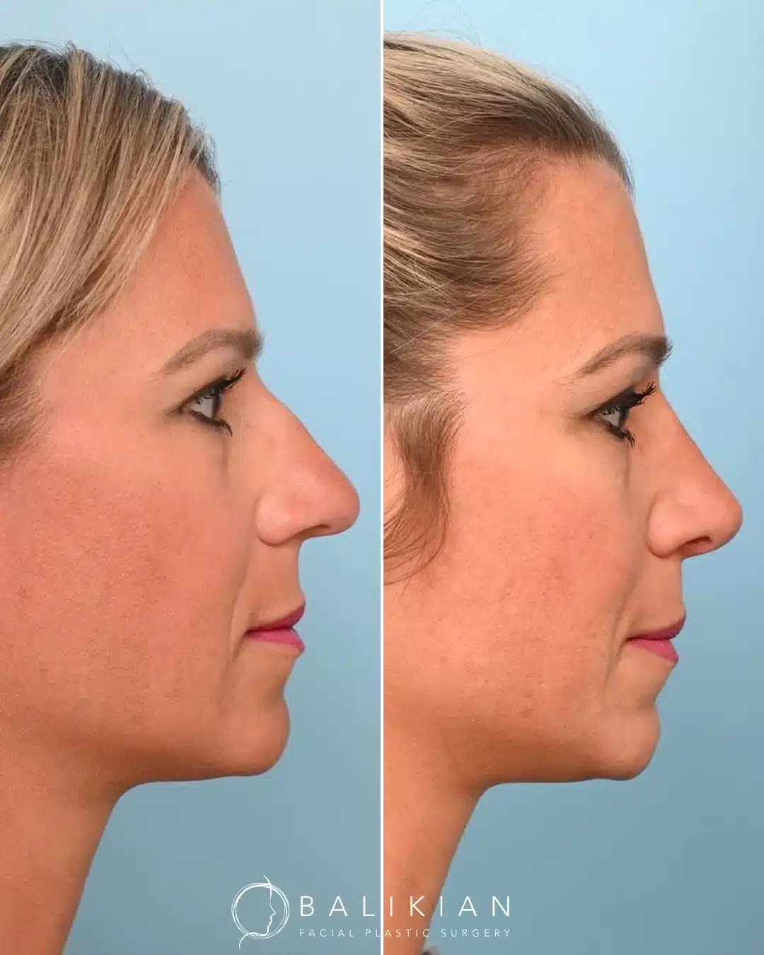 Before and after rhinoplasty, profile view: dorsal hump reduction for a straighter nasal profile.