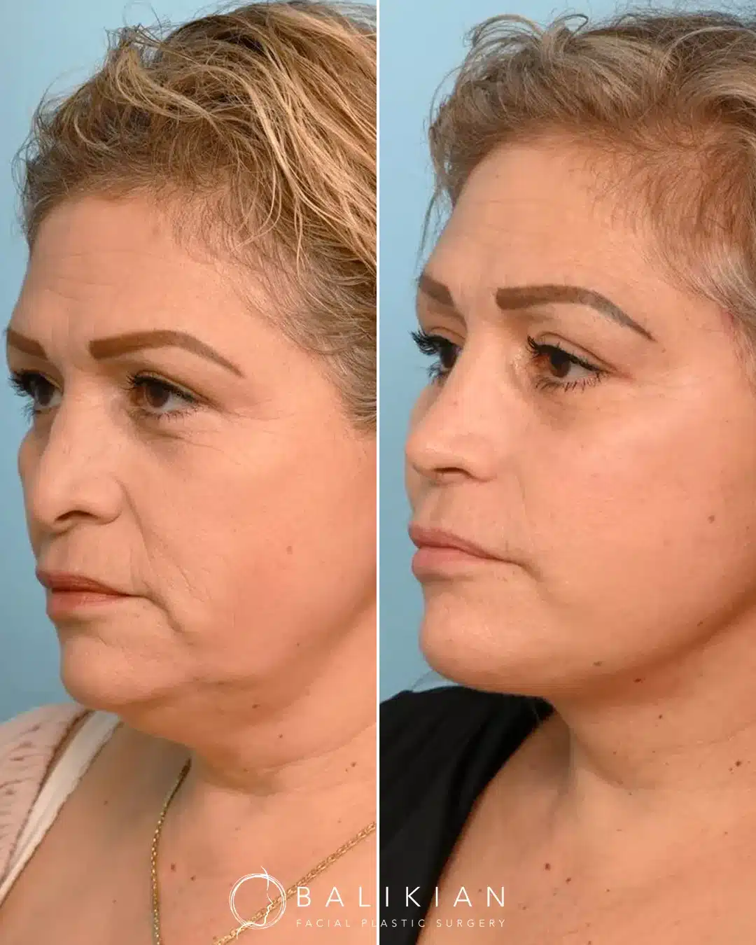 Before and after results of a deep plane facelift on a middle-aged woman, showing smoother skin, reduced sagging along the jawline, and a more defined neck contour.