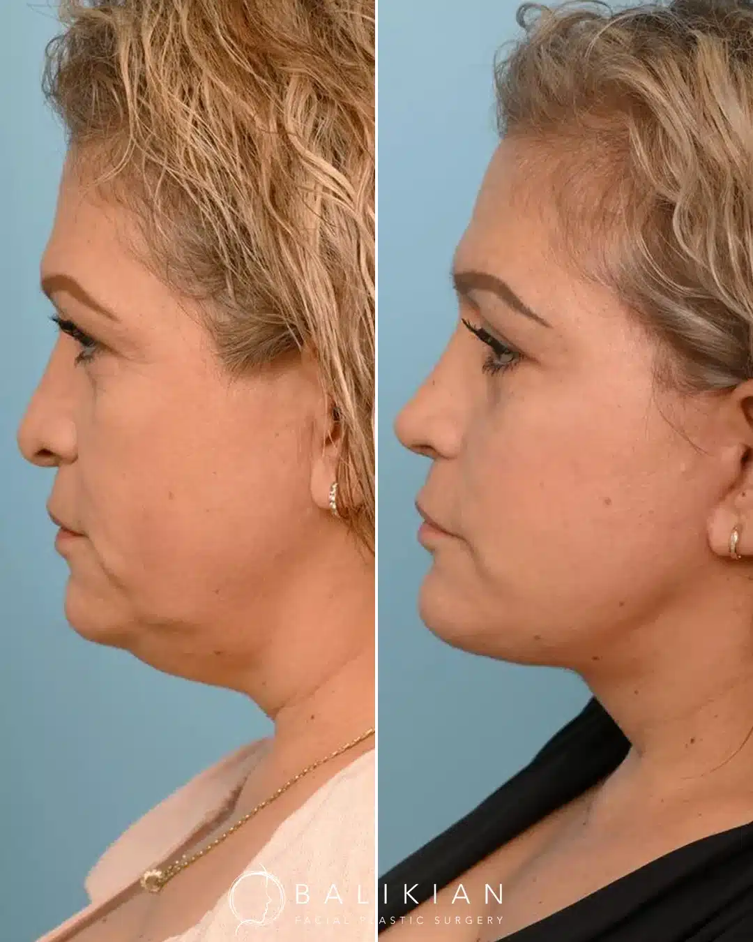 Side profile before and after a deep plane facelift on a middle-aged woman, highlighting improved jawline definition, lifted facial contours, and a smoother neck appearance.