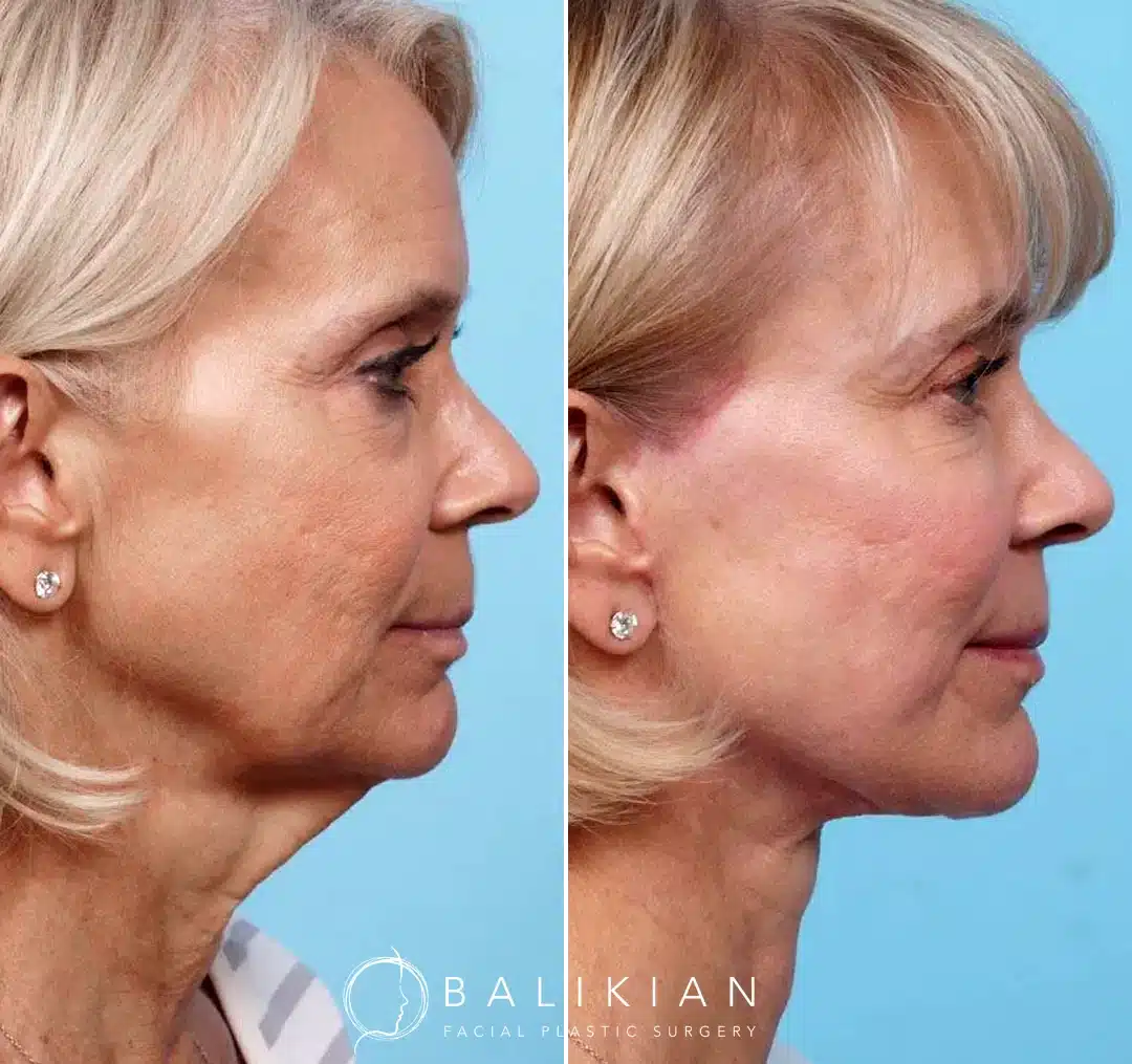 A mature woman’s side profile before and after a facelift, showing a smoother jawline, lifted cheeks, and tightened neck skin with a natural finish.