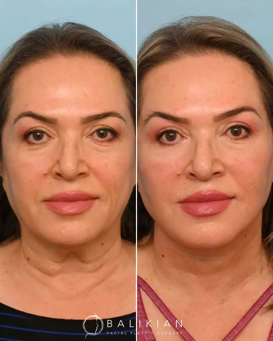 Before-and-after image of a woman in her early 60s showing the results of a customized deep plane face and neck lift with buccal fat excision by Dr. Balikian.