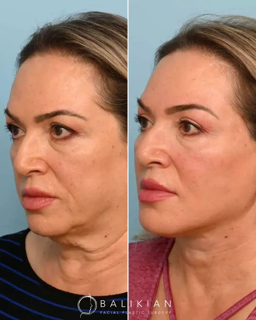 This patient in her early 60s was concerned about a heavy neckline and attached earlobe. Dr. Balikian performed a customized deep plane face and neck lift with buccal fat excision, lifting and refining her features while restoring a natural earlobe appearance.
