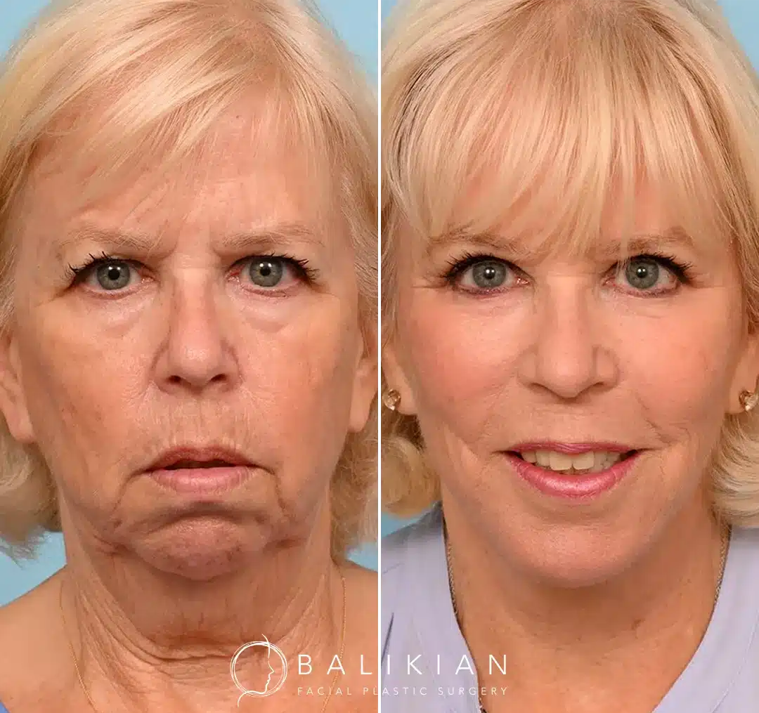 Before and after photos of an older woman with blonde hair showing the results of a facelift.