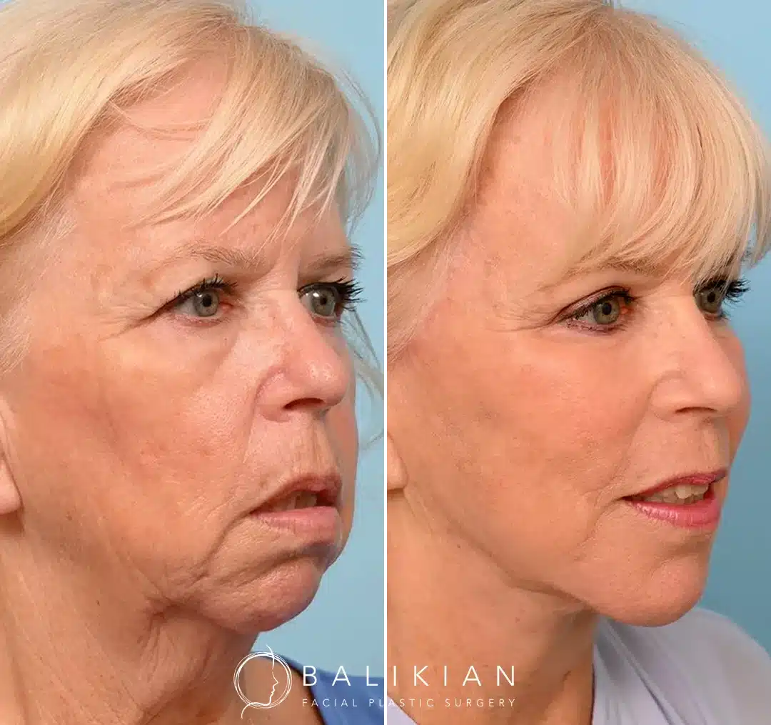 Before and after angled view of a woman with blonde hair following a facelift.