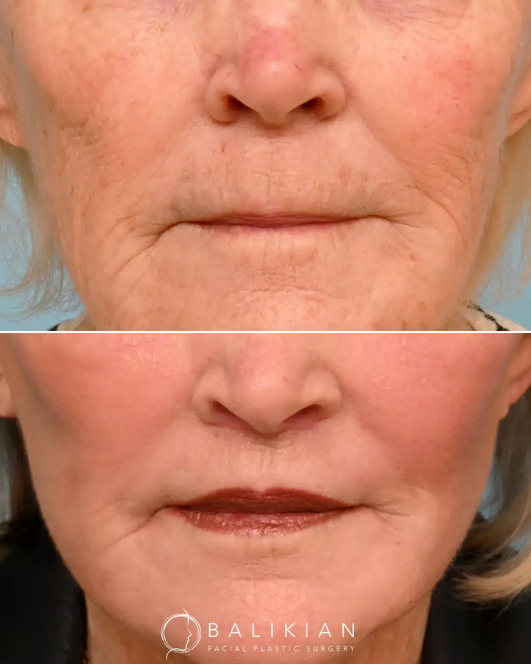 Frontal before and after of older woman following surgical lip lift. Upper lip appears lifted with more visible teeth when lips are at rest, creating a youthful appearance.