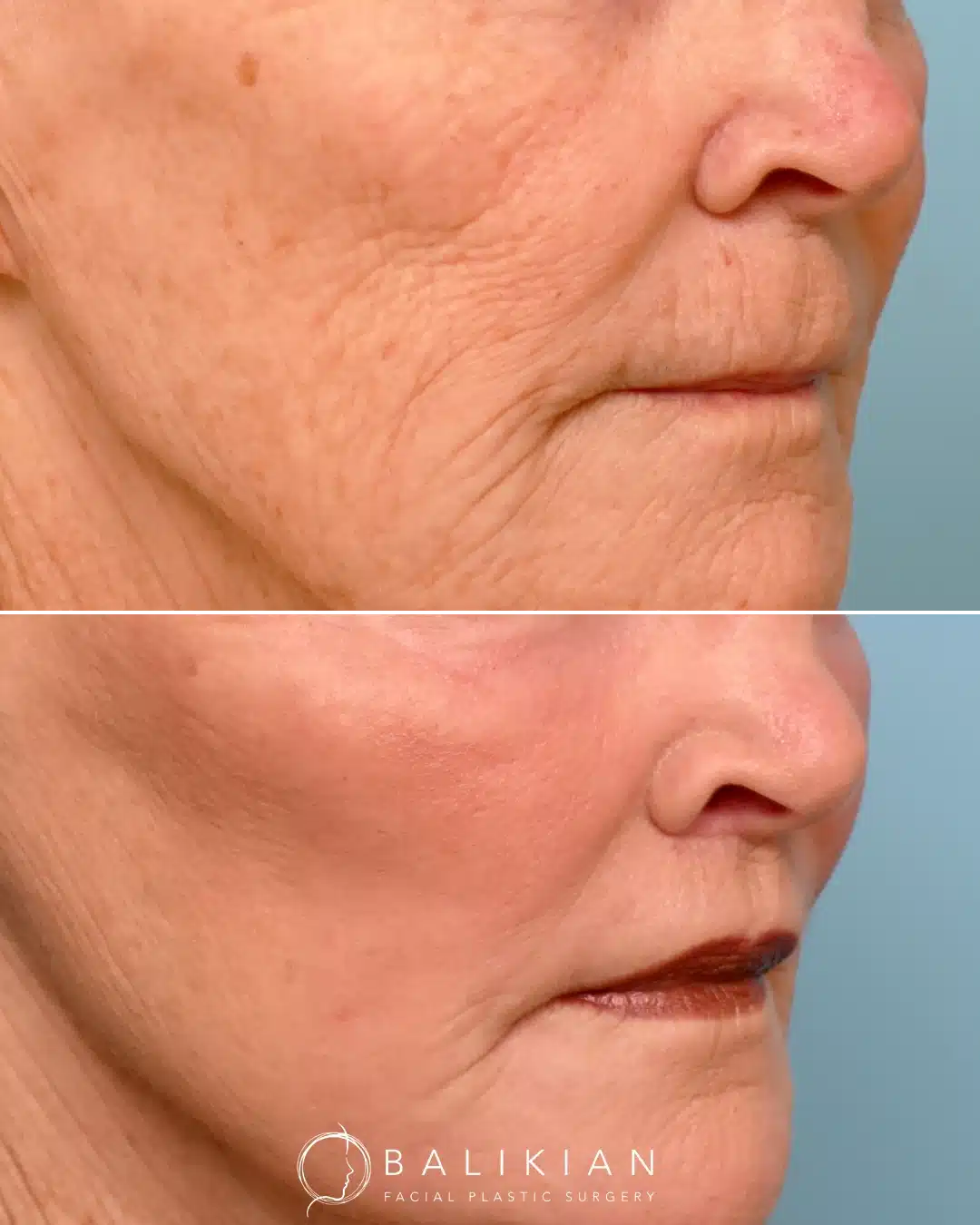 Before and after lip lift surgery, angled view of older woman. Notice enhanced cupid’s bow, refined lip contour, and reduced skin laxity above the upper lip.