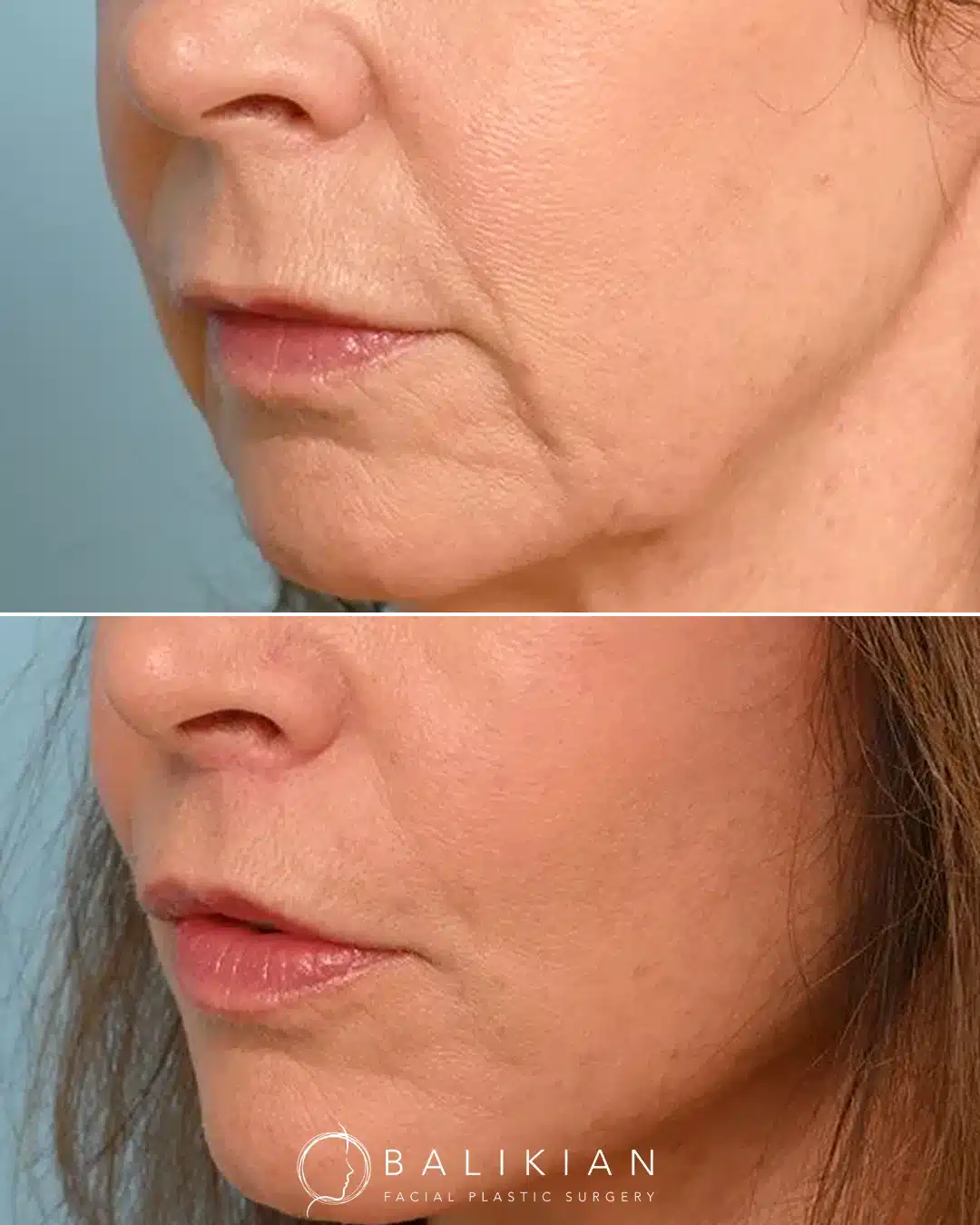 Angled view of a woman’s face before and after a surgical lip lift. The after photo shows a shortened upper lip, smoother skin around the mouth, and improved lip definition for a more youthful appearance.