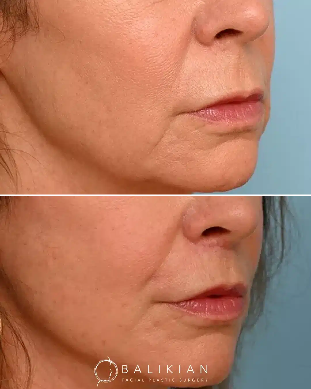Opposite angled view of the same patient before and after a surgical lip lift. The after photo highlights enhanced lip contour, reduced distance between the nose and upper lip, and subtle rejuvenation of the lower face.