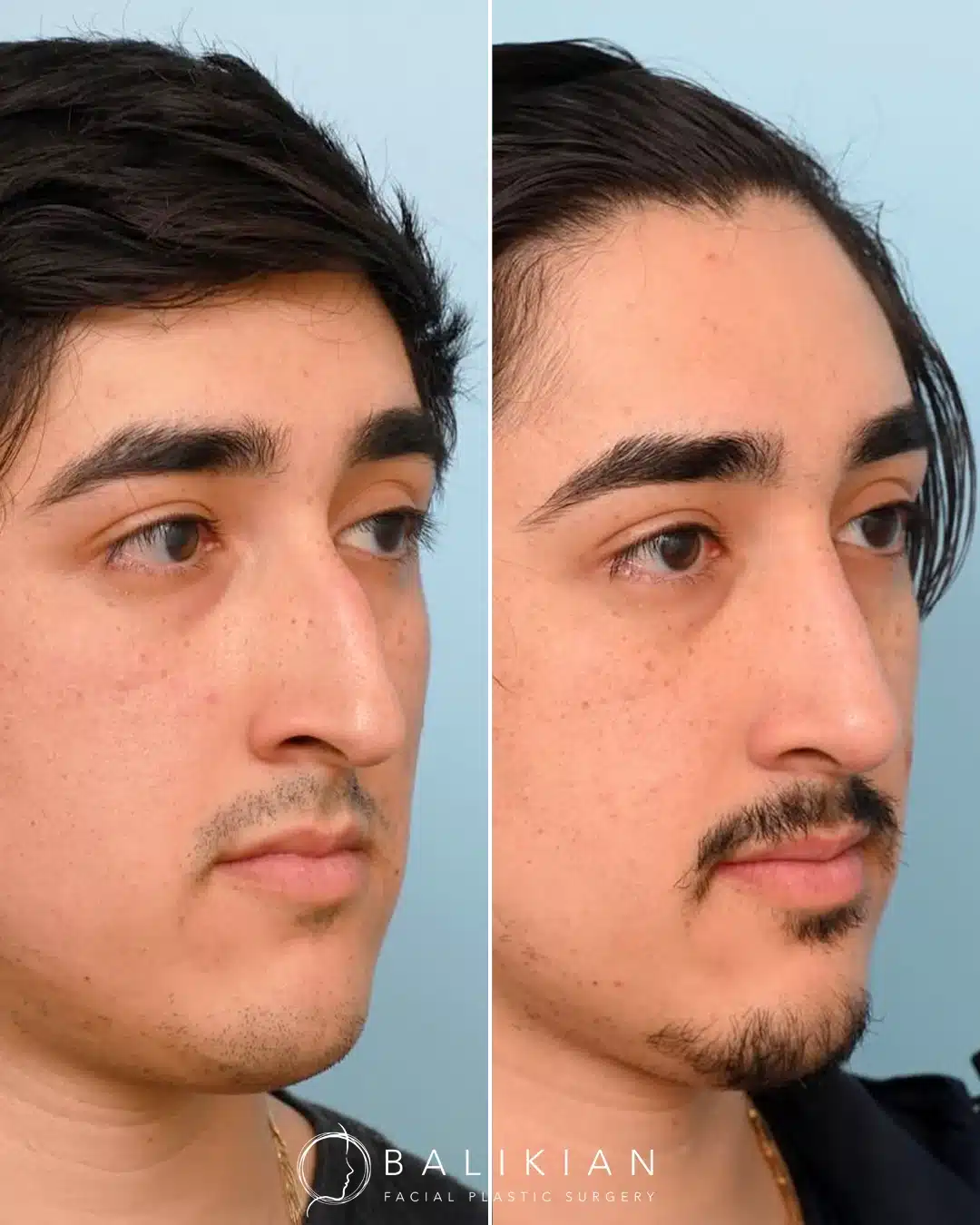 Male rhinoplasty before and after, oblique view: reduced dorsal hump and a straighter bridge.