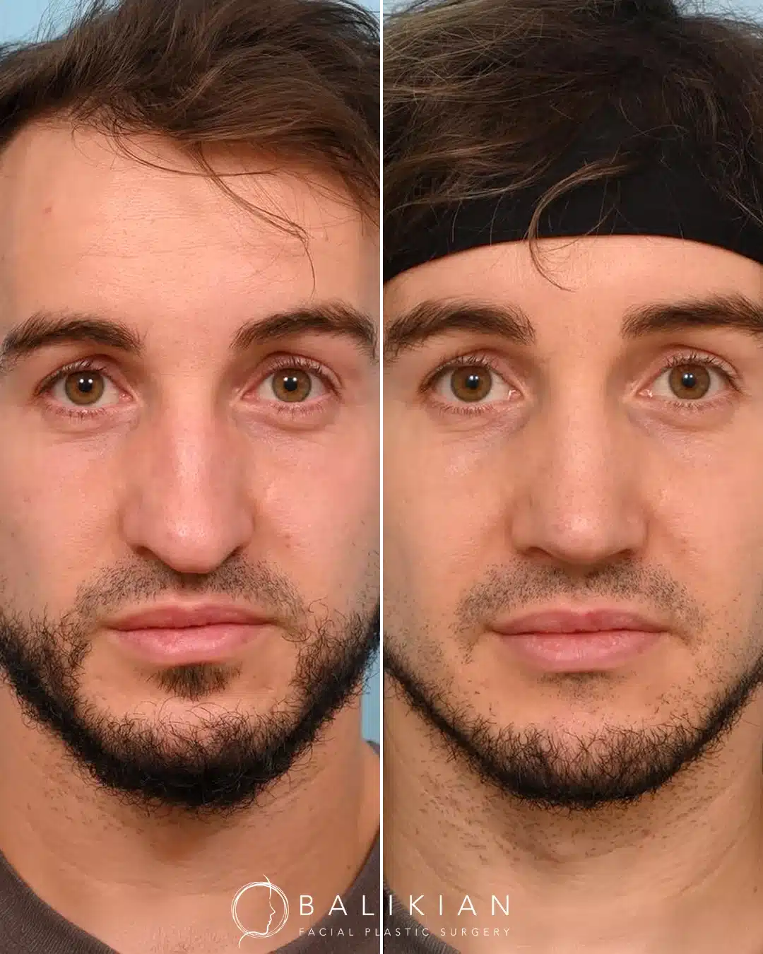 Before and after rhinoplasty, frontal view. Bridge straightened and tip refined for a natural masculine result.