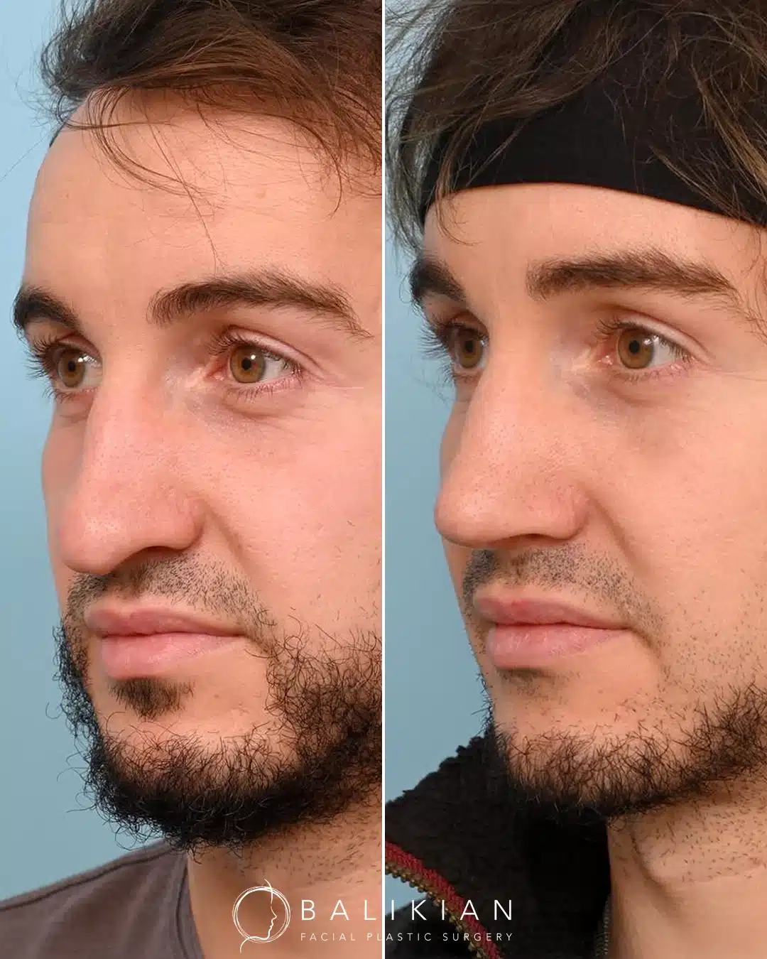 Before and after rhinoplasty, three-quarter view. Smoother bridge and balanced tip definition.
