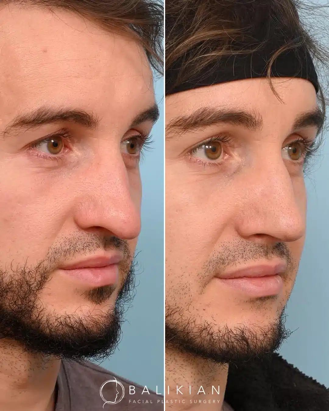Before and after rhinoplasty, opposite three-quarter view. Bridge straightened with subtle tip refinement.