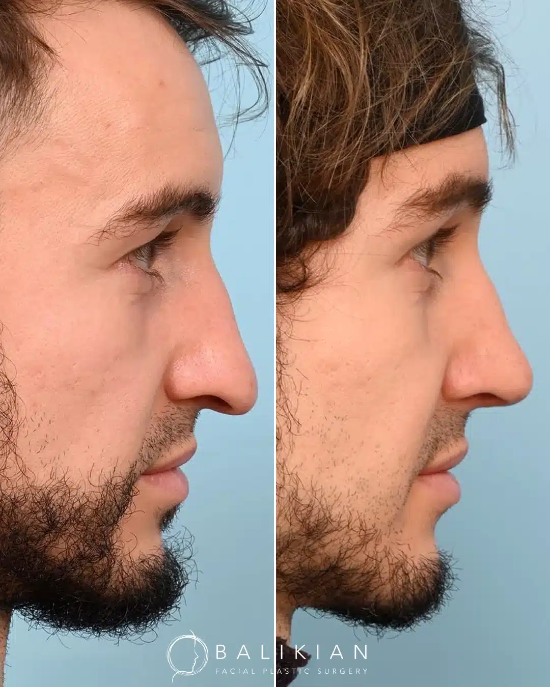 Before and after rhinoplasty, profile view. Dorsal hump reduced and nasal line straightened.