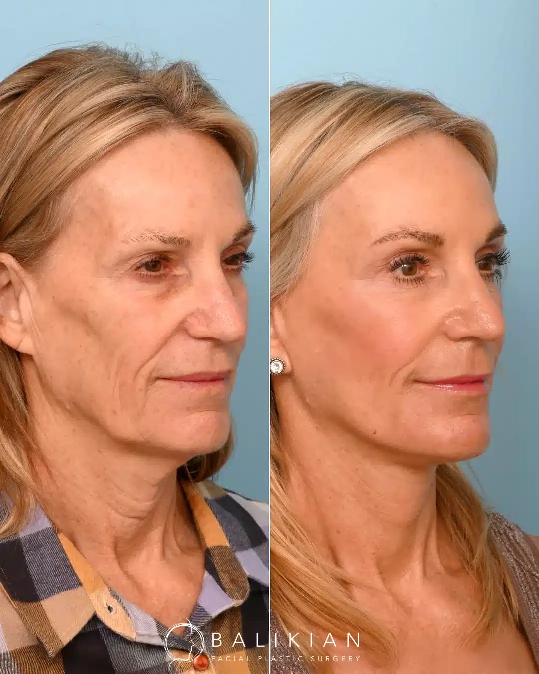 Before and after facelift and neck lift showing smoother neckline and natural lift.