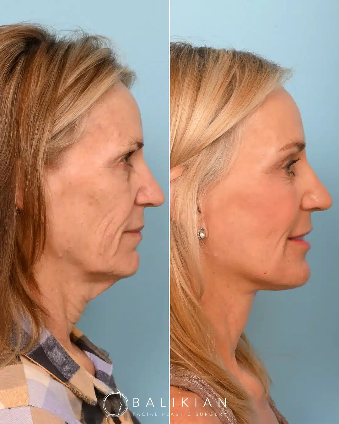 Profile before and after facelift and neck lift with tightened neck and sculpted jawline.