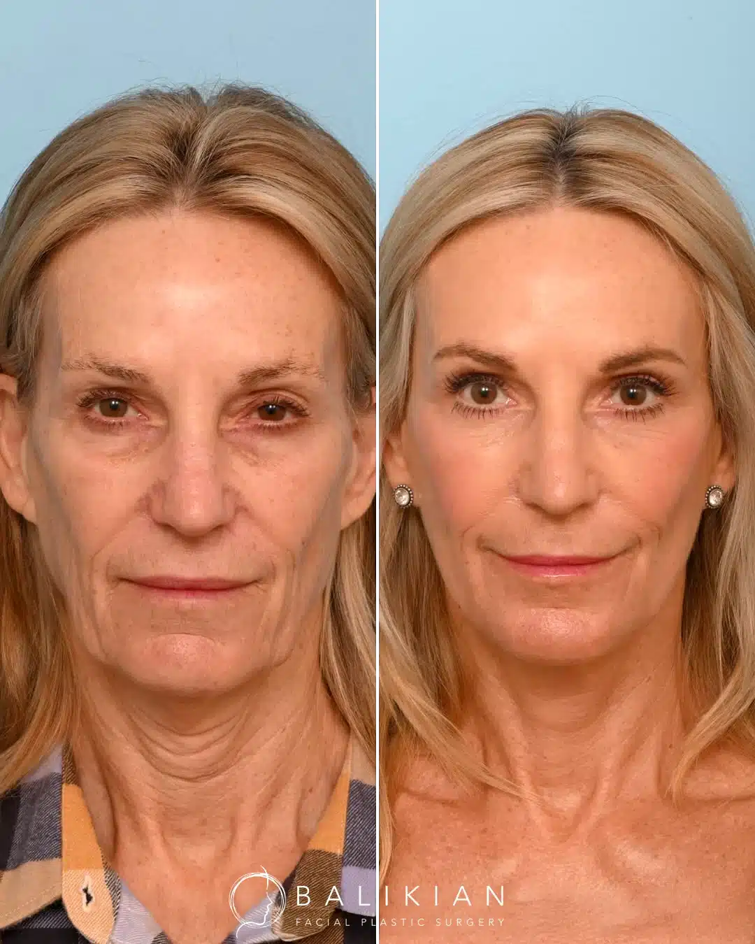 Front view facelift and neck lift before and after showing balanced, rejuvenated features.