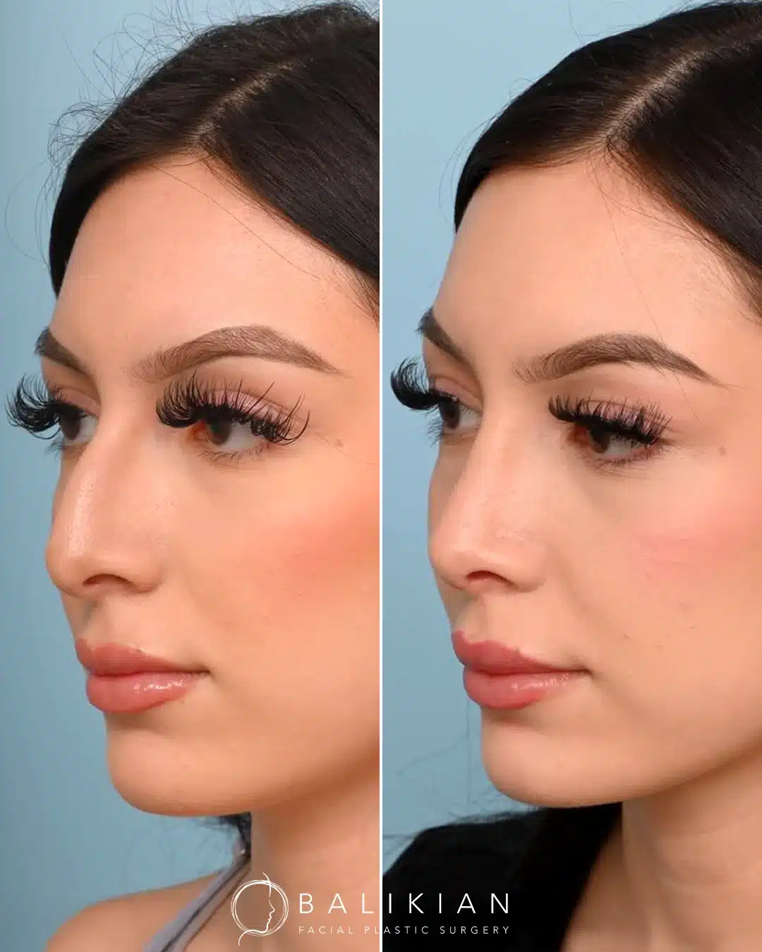 Before and after rhinoplasty, three-quarter view. Dorsal hump smoothed and tip refined for a softer profile.