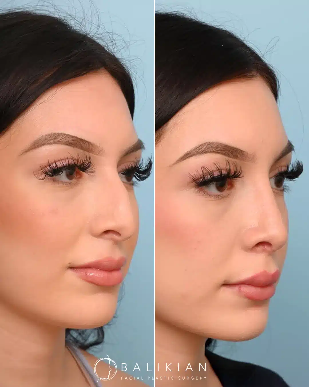 Before and after rhinoplasty, opposite three-quarter view. Sleeker bridge with natural tip definition.