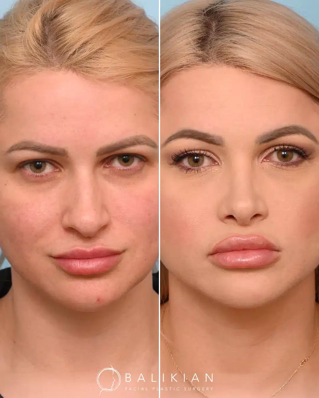Before and after rhinoplasty, frontal view. Narrower bridge and improved tip symmetry.