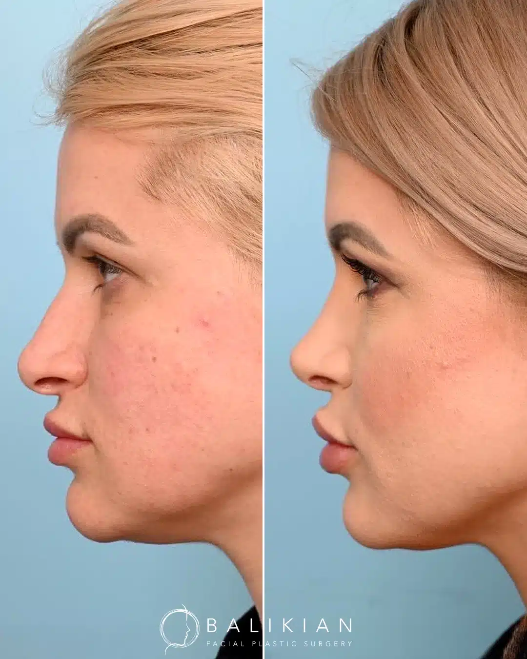 Before and after rhinoplasty, profile view. Dorsal hump reduction with gentle tip rotation.