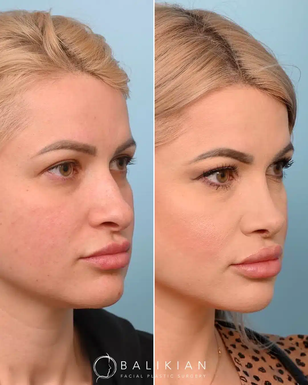 Before and after rhinoplasty, three-quarter view. Smoother dorsum and refined tip for balanced contours.