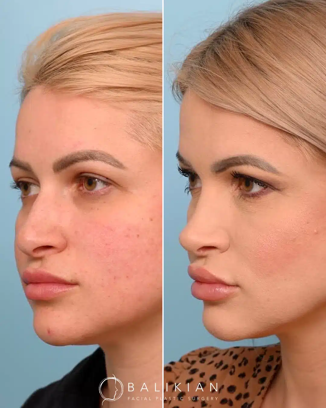 Before and after rhinoplasty, opposite three-quarter view. Sleeker bridge and tip refinement for a harmonious profile.