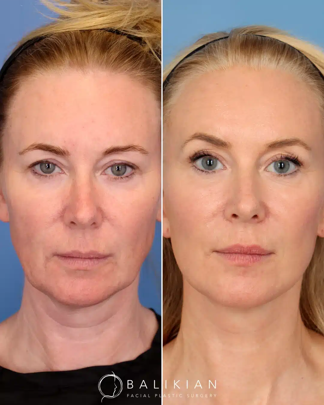 Frontal view of a woman whose face appears lifted and more symmetrical after a deep plane facelift, with softened folds around the mouth and refreshed eye area.