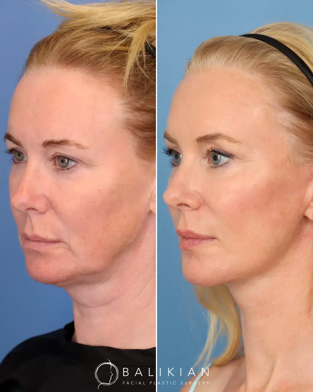 Left oblique angle showing a woman with a noticeably firmer jawline, reduced jowls, and a contoured neck following facial rejuvenation surgery.