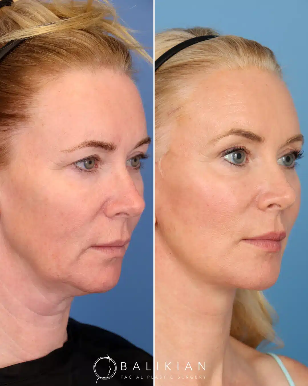 A woman shown from a right oblique angle with improved jawline definition and a smoother neck after a deep plane facelift. Cheeks appear lifted, and skin texture is visibly more even.