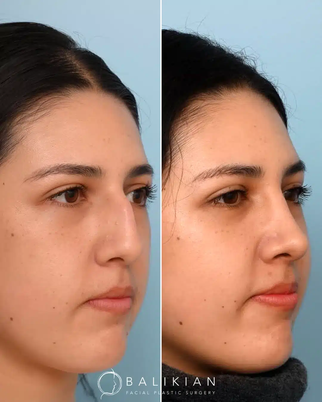 Before left, after right: patient rhinoplasty, left oblique view. Reduced dorsal hump and refined tip.