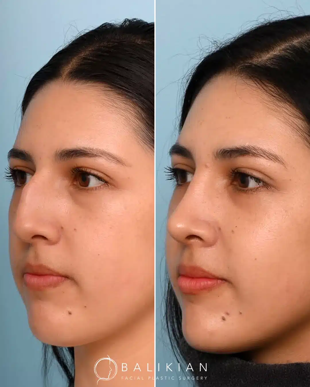 Before left, after right: patient rhinoplasty, right oblique view. Straighter bridge and smoother tip.