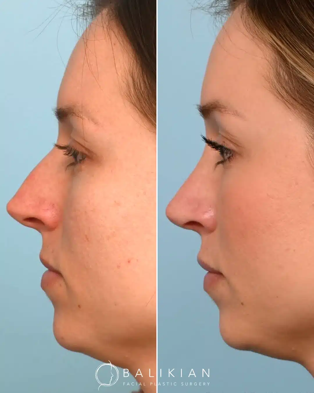 Before left, after right: rhinoplasty, left profile. Dorsal hump reduction with improved tip projection.