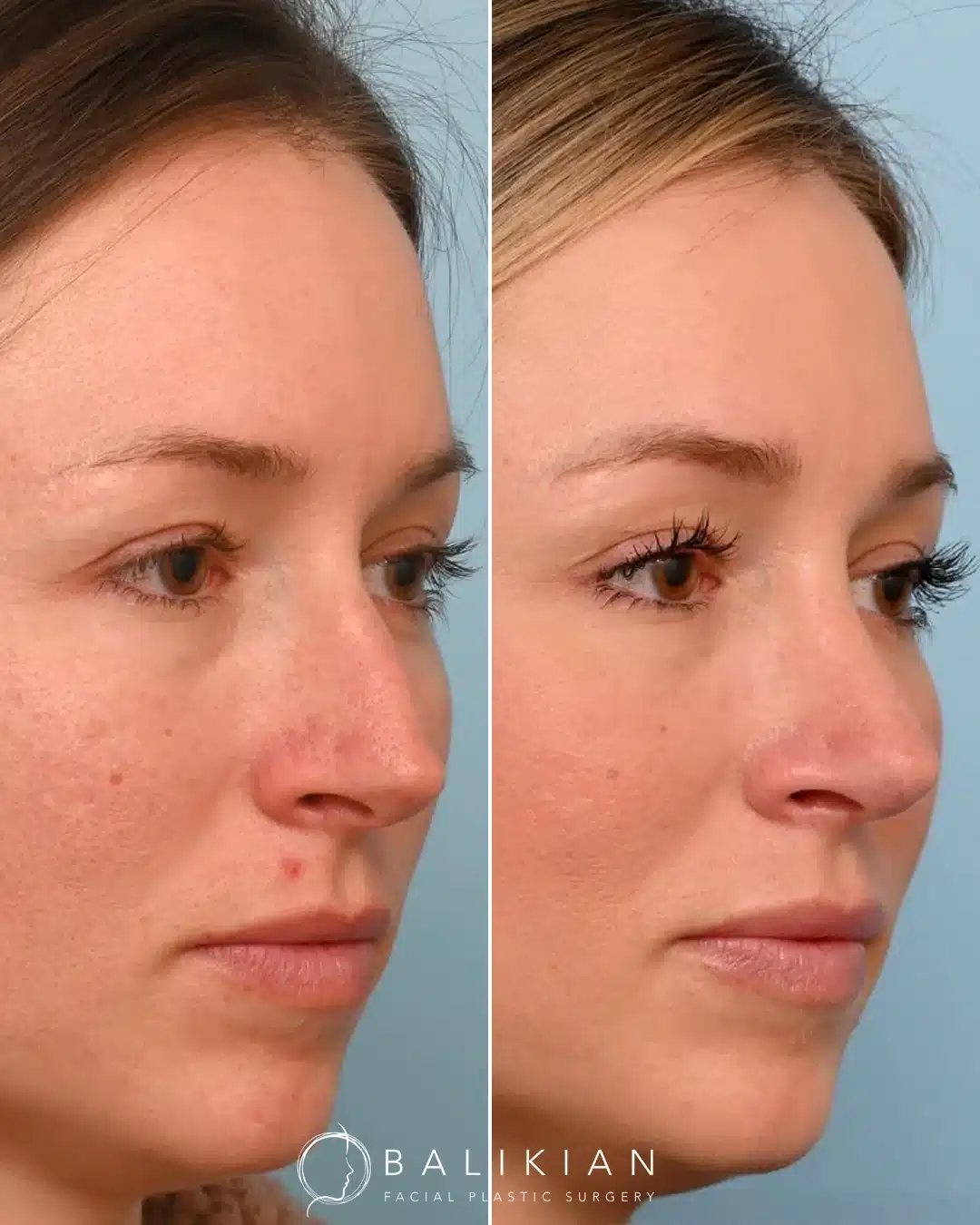 Before left, after right: rhinoplasty, left oblique view. Smoother bridge and balanced profile.