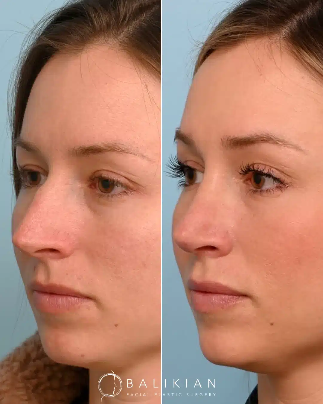 Before left, after right: rhinoplasty, right oblique view. Bridge reduced and tip refined.