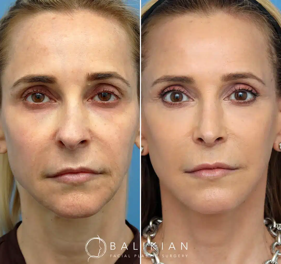 Front view before and after deep plane facelift in San Diego showing rejuvenated midface, softened folds, and natural youthful balance.