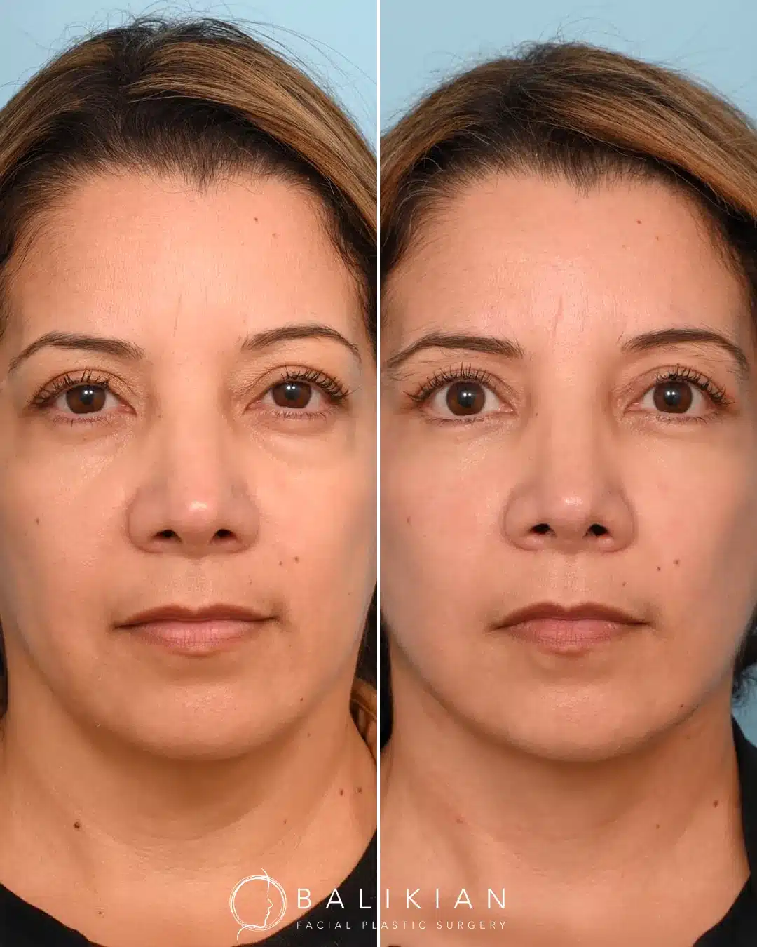 Facelift and neck lift before and after angled view in San Diego highlighting smoother neckline, vertical lift, and refreshed expression.