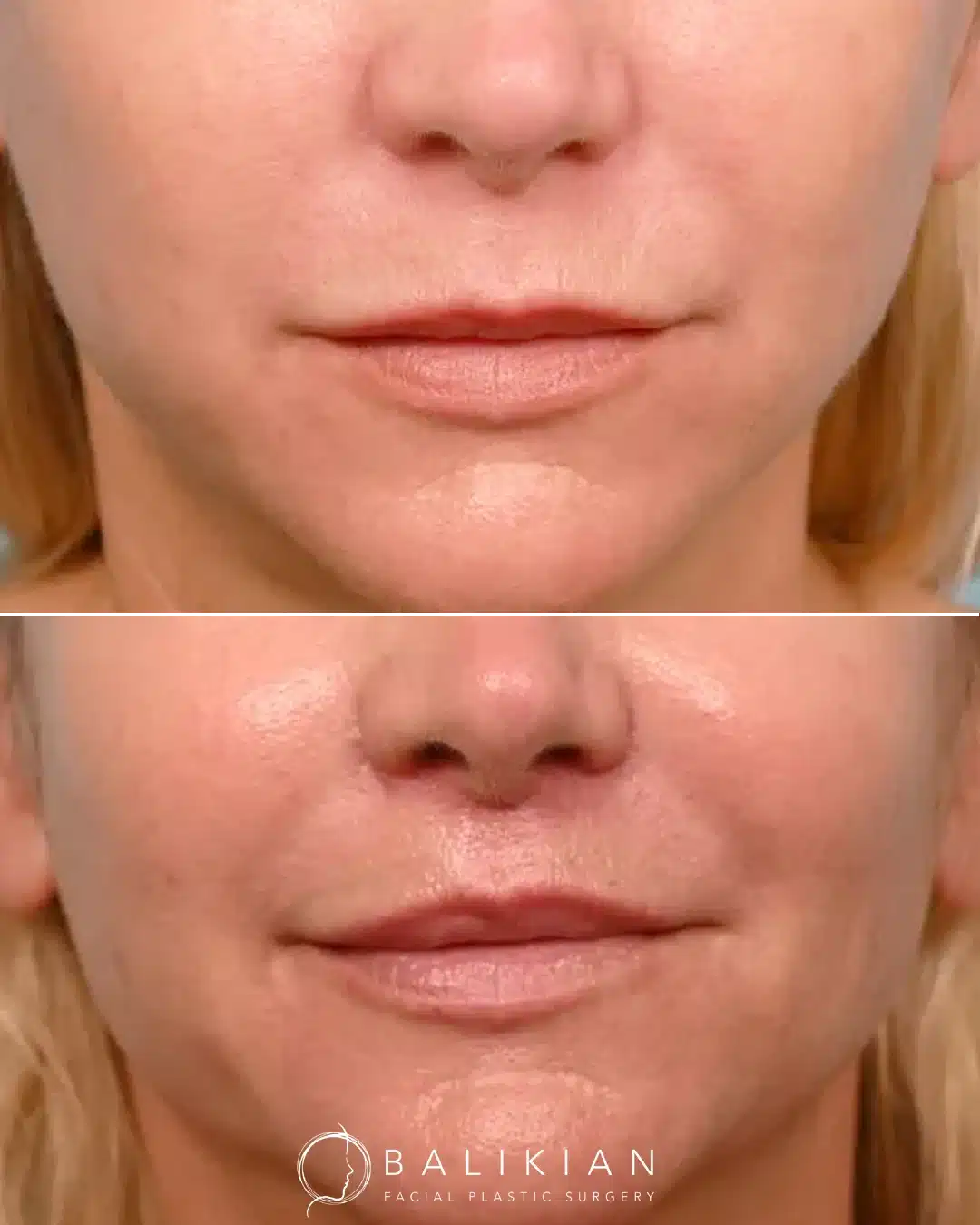 Before and after frontal view of a female patient who underwent a surgical lip lift with Dr. Richard Balikian, showing a shortened philtrum, enhanced upper lip definition, and improved facial balance.