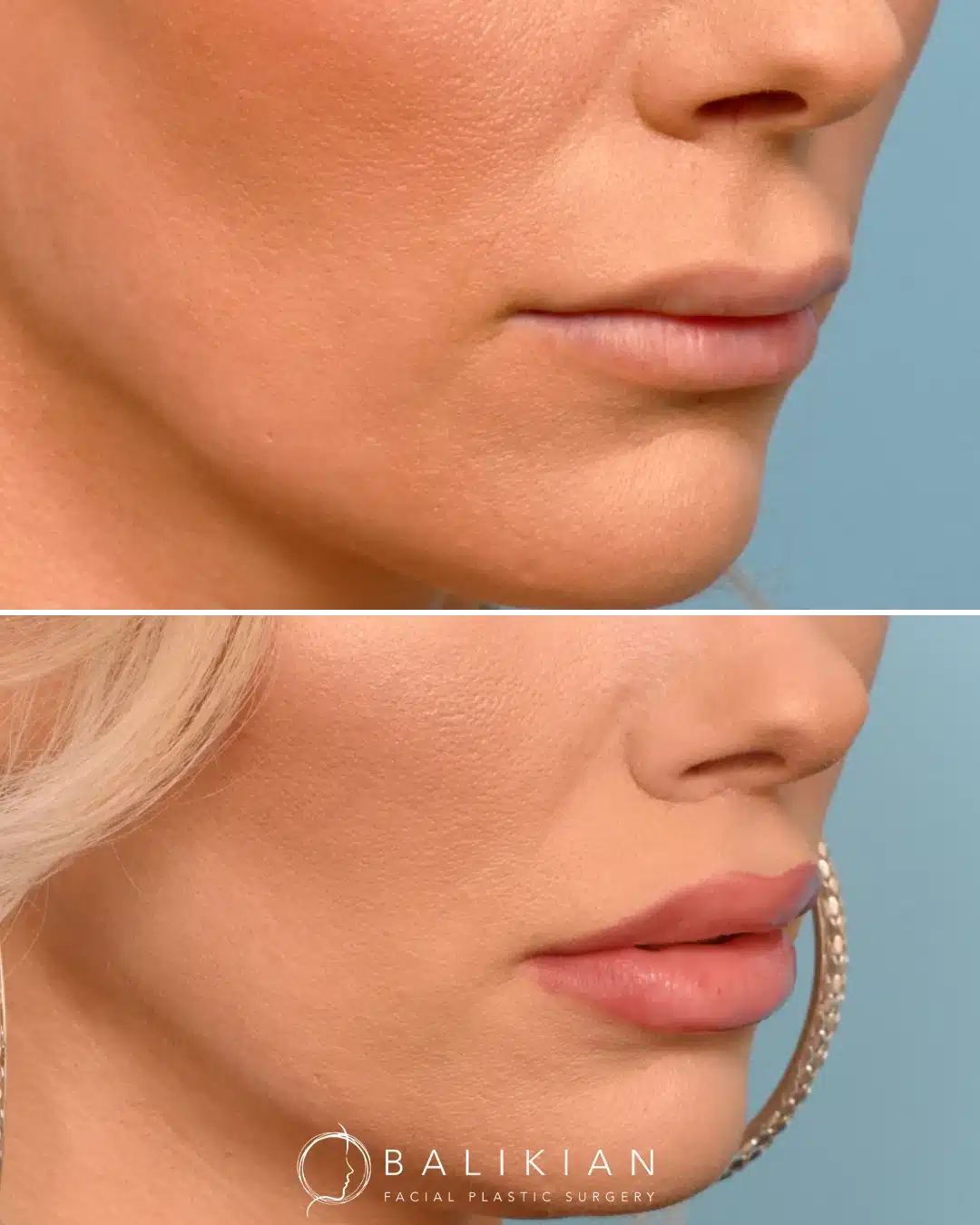 Close-up, angled before-and-after photos of a woman’s lower face and lips showing enhanced lip volume, shorter distance between nose and upper lip, and improved lip contour after a surgical lip lift