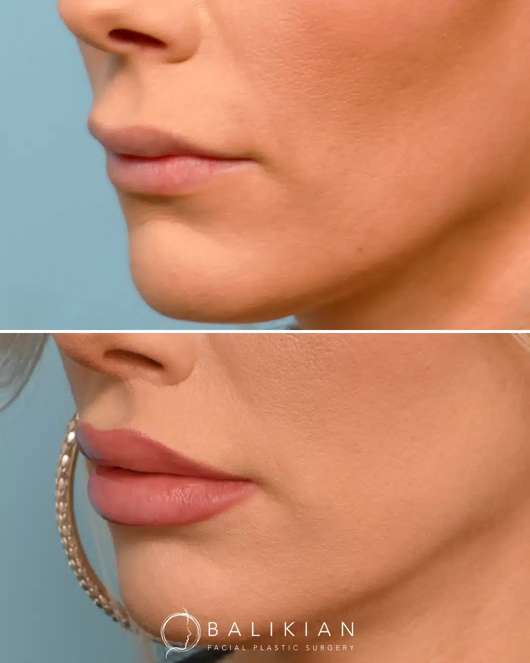 Angled before-and-after close-up of the lips from the other side, revealing increased upper lip show, refined shape, and enhanced overall symmetry after a surgical lip lift