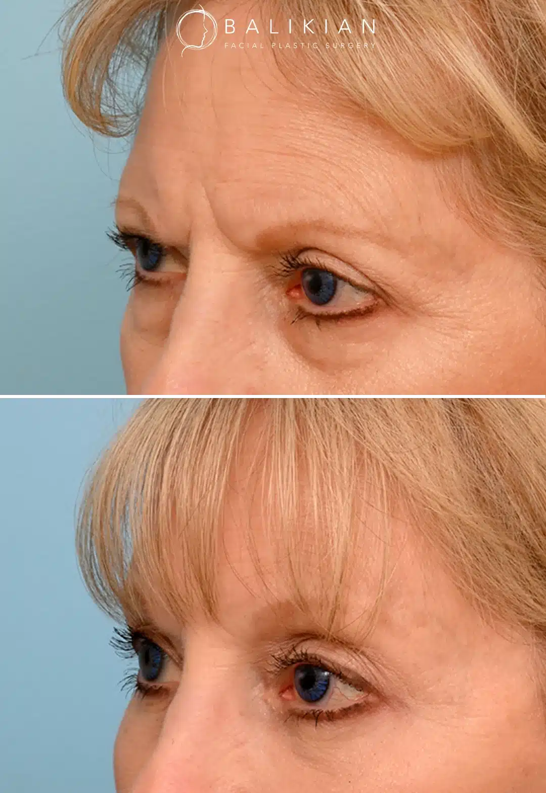 Oblique view of a woman before and after temporal brow lift, showing smoother forehead skin, lifted outer brows, and reduced upper eyelid hooding