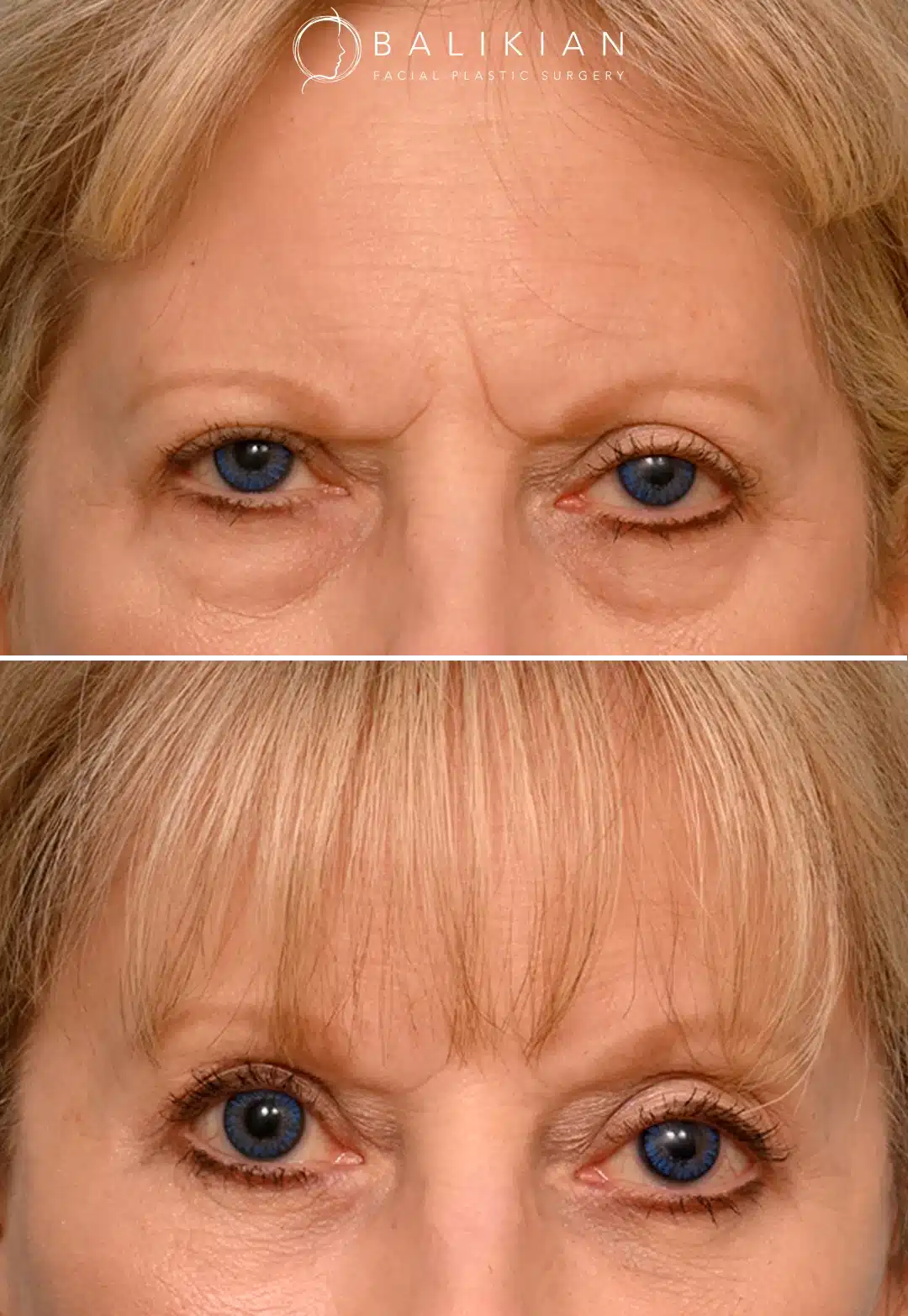 Frontal view of a woman before and after temporal brow lift, with softened frown lines, elevated brows, and a more open, refreshed eye appearance