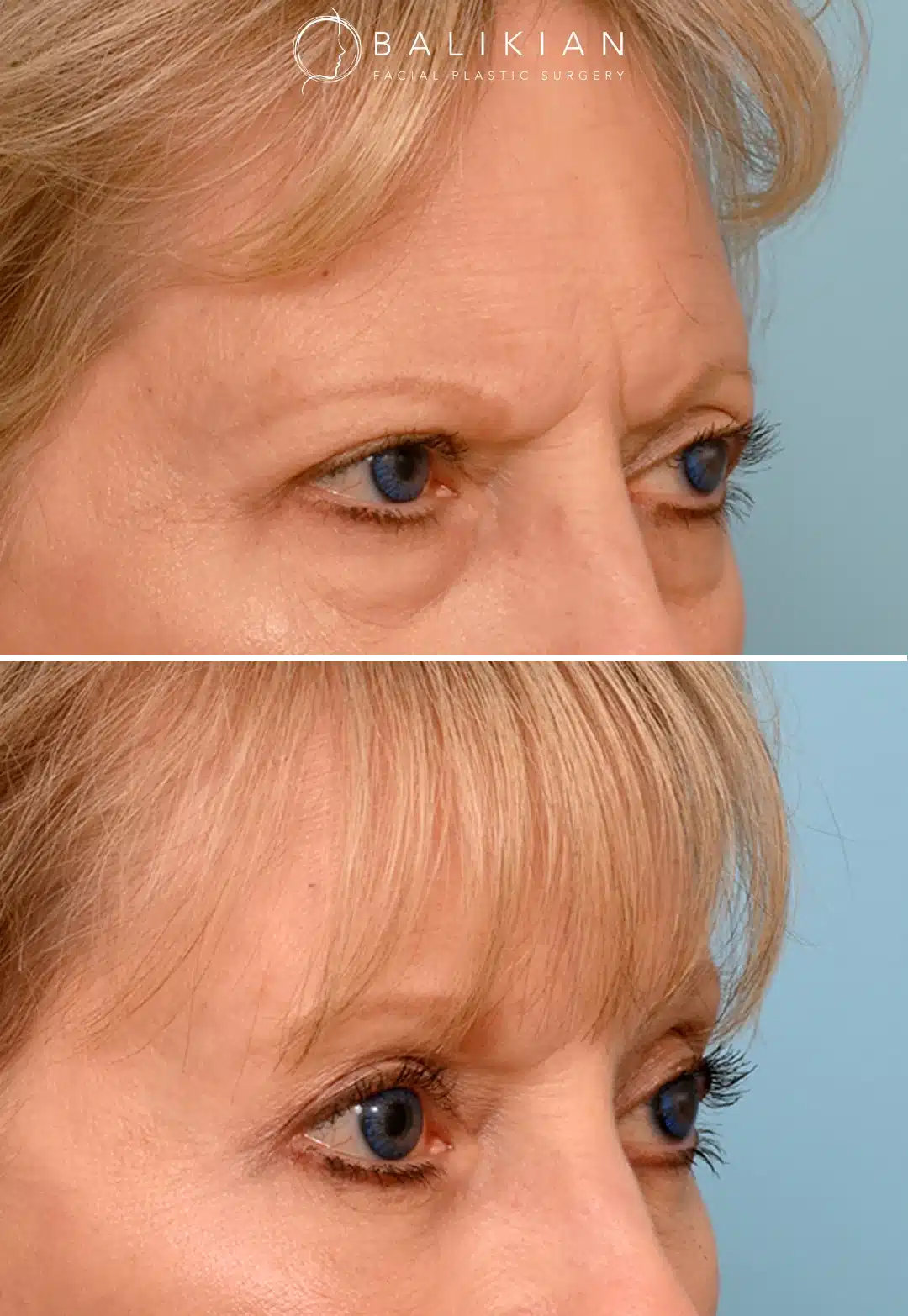Opposite oblique view of a woman before and after temporal brow lift, highlighting lifted outer brows, diminished forehead creases, and reduced heaviness over the eyes