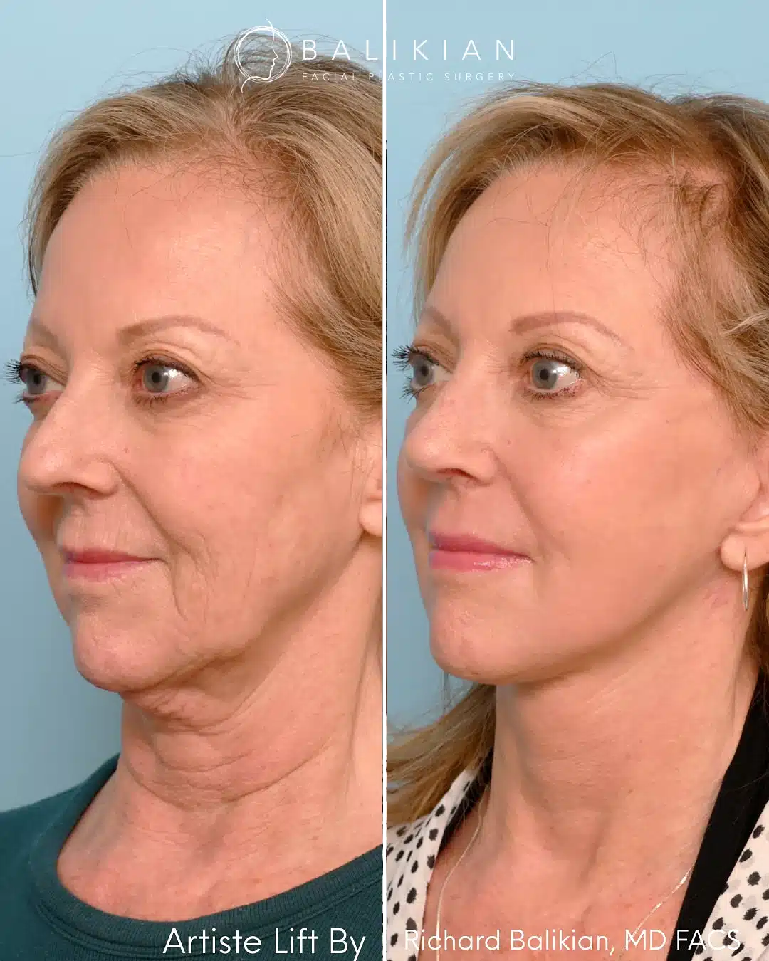 Deep plane facelift before and after oblique left view. Patient demonstrates lifted cheeks, firmer neck contour, and softened folds after Artiste Lift™.