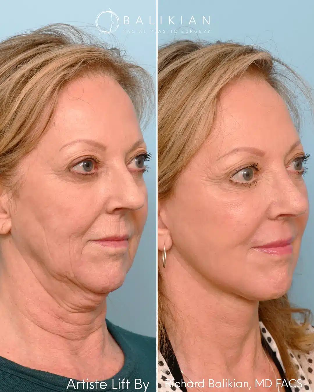Deep plane facelift before and after oblique right view. Artiste Lift™ results highlight reduced jowling, refined jawline, and restored cheek volume.